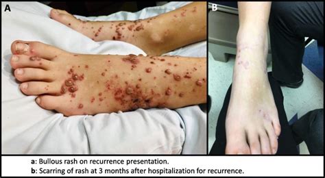 Recurrent Henoch Schönlein Purpura With Bullous Rash And Pulmonary