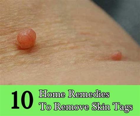 10 home remedies to remove skin tags