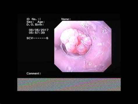 EMR Of A Squamous Cell Papilloma On Top Of A Residual Esophageal Varix YouTube