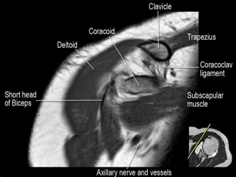 Mri Musculo Skeletal Section Mri Anatomy Of The Shoulder Coronal View