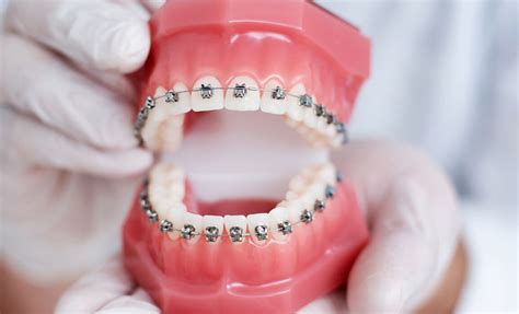 Why Getting Tooth Braces Makes Sense Even In 2022