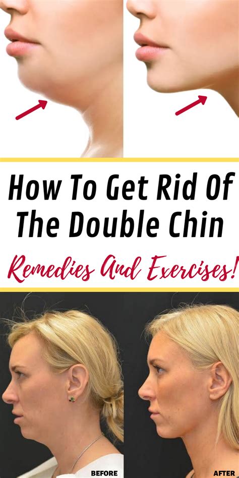 Get Rid Of Double Chin Naturally In 2020 Double Chin Rosacea Skin