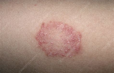 Tinea Corporis Causes