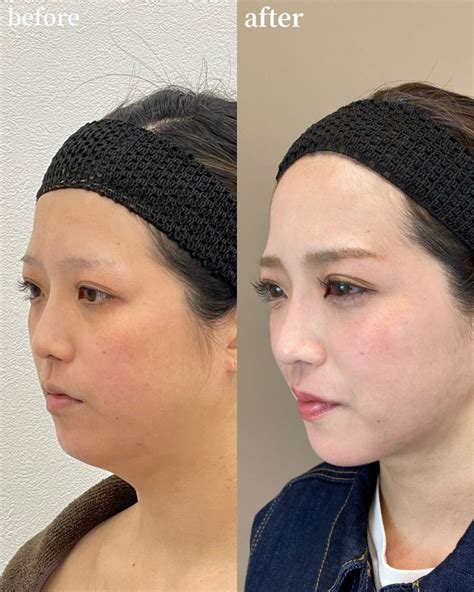 症例写真 奥村 公貴：tcb式小顔脂肪吸引 美容整形はtcb東京中央美容外科