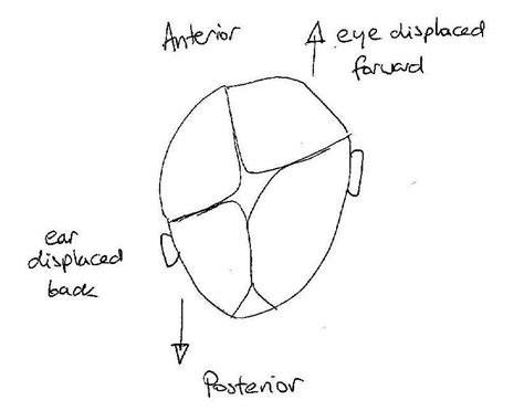 Plagiocephaly is most often treated with one many infants with plagiocephaly — especially those born with muscular torticollis, an imbalance of. plagiocephaly-(flat-head-syndrome)-pillow Images - Frompo - 1