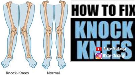 How To Fix Knock Knees Six Best Exercises For Knock Knees Youtube