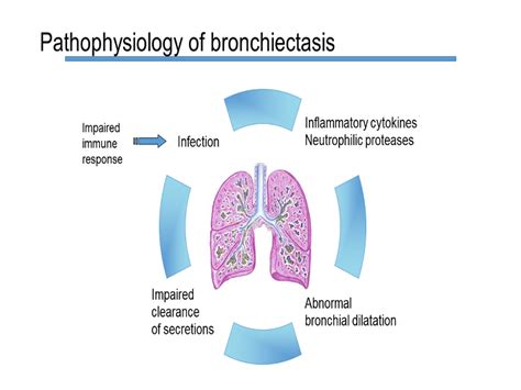 Pathophysiology Of Bronchiectasis Bronchiectasis Diagnosis And