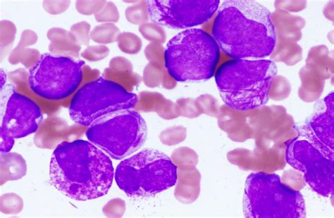 Acute Promyelocytic Leukemia Ucla Olive View Internal Medicine