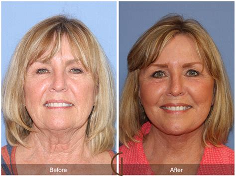 Dr Kevin Sadati Releases Tip Sheet On Facelift Vs Neck Lift When A