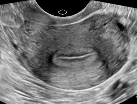 Figure Transversecoronal View Of The Uterus Contributed By Dr
