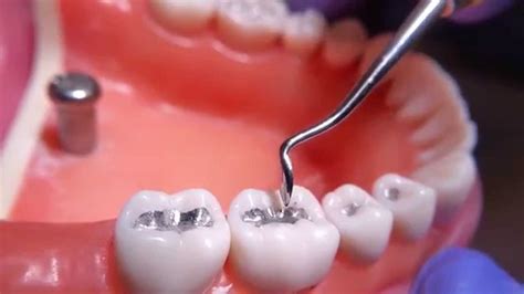 Amalgam Or Composite Filling St Lawrence Dentistry