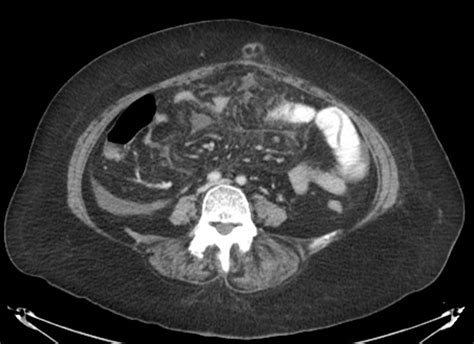 Pancreatitis With Persistent Vomiting And Abdominal Pain Eurorad