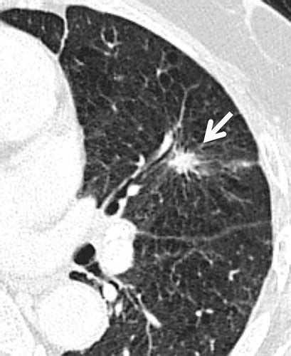 Guidelines For Management Of Incidental Pulmonary Nodules Detected On Ct Images From The