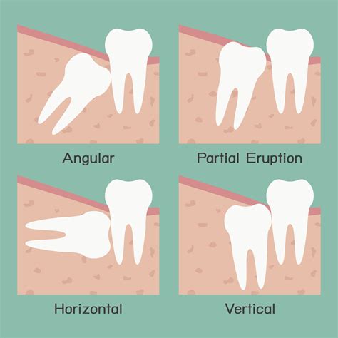 It's usually recommended that you take a day or two off work after having a wisdom tooth removed. Extraction, Bone Grafting & Wisdom Teeth Draper | Walter ...