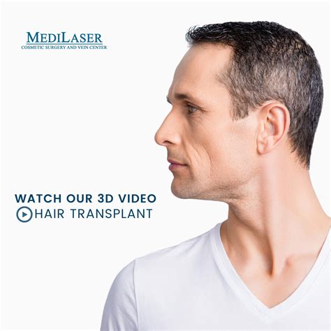 Watch Our 3d Hair Transplant Video Frisco Texas Medilaser Surgery And Vein Center