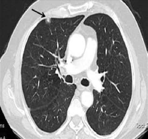 A 12 Mm Diameter Pulmonary Nodule With Subpleural Placement In The