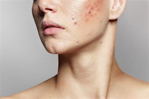 Pimple Mark Pictures Download Free Images On Unsplash