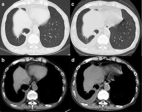 Pulmonary Actinomycosis Mimicking A Lung Metastasis From Esophageal