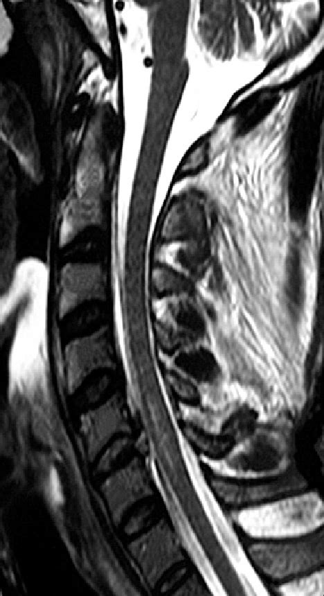 Sagittal Mri Showing T2 Weighted Cervical Disc Fragment Extrusion At