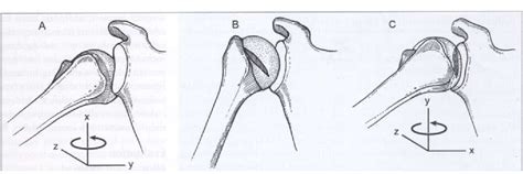 Figure 2 From Arthroscopic Treatment Of Anterior Glenohumeral