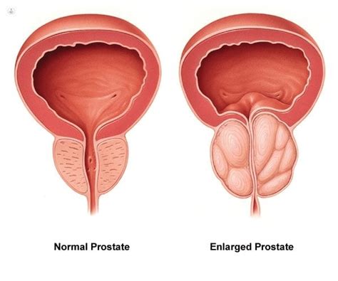 Prostate Artery Embolization Enlarged Prostate Center California