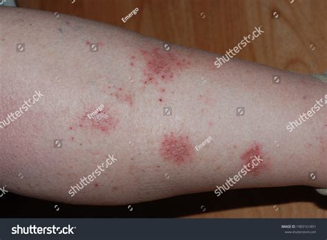 Стоковая фотография 1983161891 Nummular Eczema On Leg Nummular Dermatitis Shutterstock