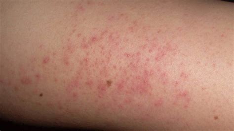 Red Bumps On Upper Arms The Best Porn Website
