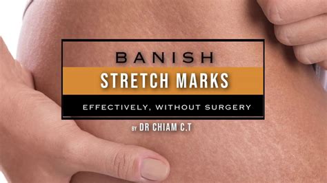 Stretch Marks How They Appear And Options To Reduce Their Appearance Youtube