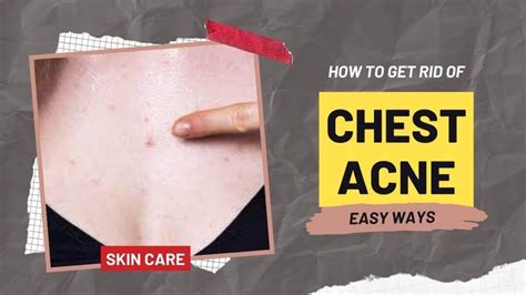 How To Get Rid Of Chest Acne In 16 Easy Ways Natural Treatments 2023