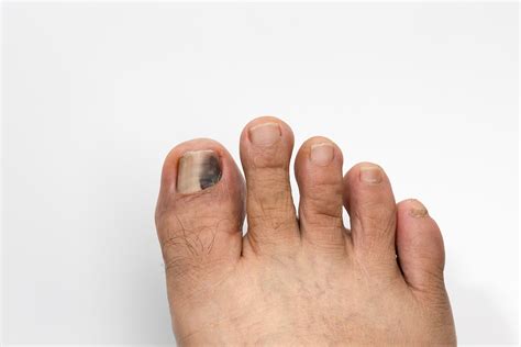 Pain And Discoloration Under Big Toenail Nail Ftempo