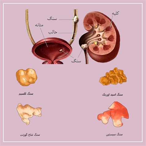 علل افرایش احتمال سنگ کلیه در زنان دکتر عاملی