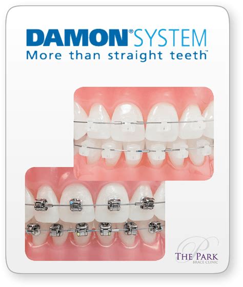 Damon Braces Derby Crooked Teeth Straightening Park Brace Clinic