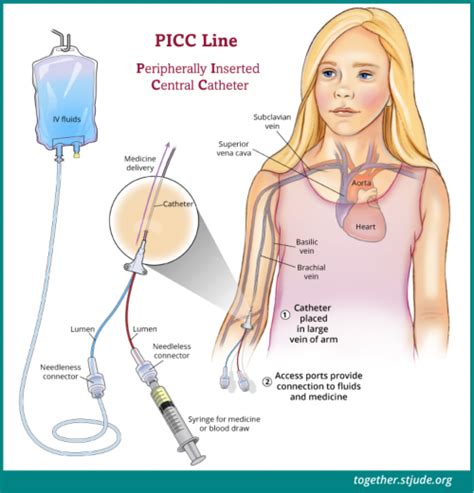 Picc Line For Childhood Cancer Patients Together