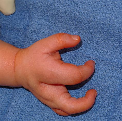 Central Deficiency Congenital Hand And Arm Differences