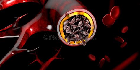 Anemia De La Célula Falciforme Ejemplo Que Muestra El Vaso Sanguíneo