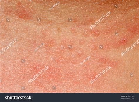 Allergic Rash Dermatitis Skin Texture Patient Foto Stock 62417437