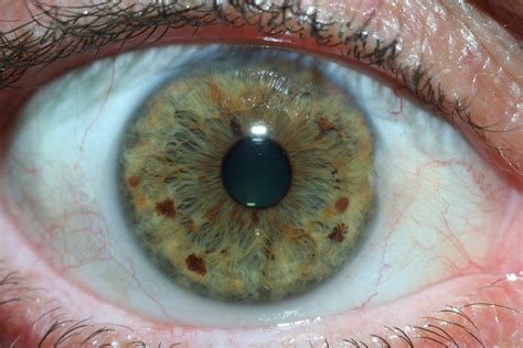 Iridology Pictures And Meanings Maikong Iridology Cameras And Iriscope