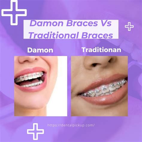 Damon Braces Vs Traditional Braces Detailed Comparison