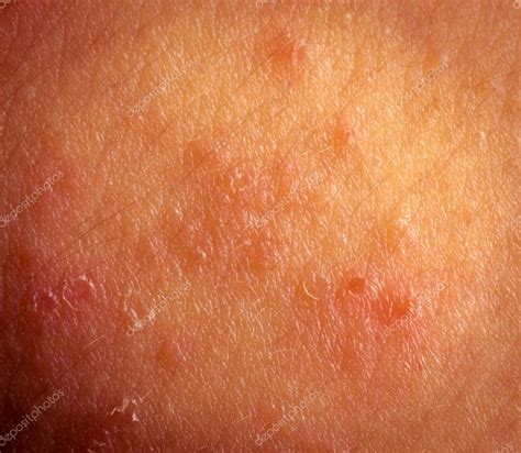 Fotos Dermatitis Textura De La Piel De Síntomas De La Dermatitis
