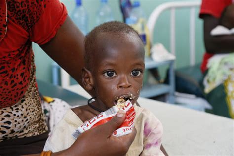 Malnutrition Kwashiorkor And Marasmus — Symptoms And Treatment