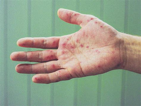 Palm Rash Causes Pictures And Treatments