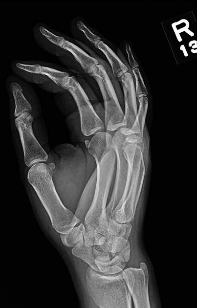 Boxer Fracture Radiology Case