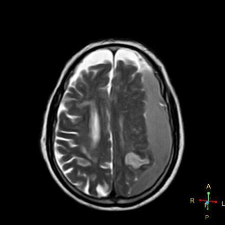 Acute Subdural Hematoma And Cerebral Infarction Radiology Case