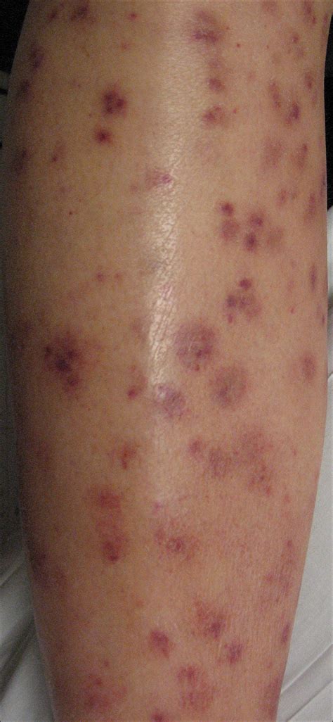 Acute Inflammatory Skin Reaction During Neutrophil Recovery After