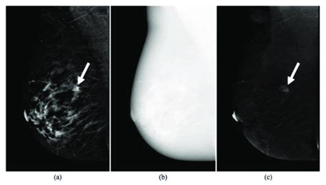 Images Produced By Contrast Enhanced Spectral Mammography Cesm