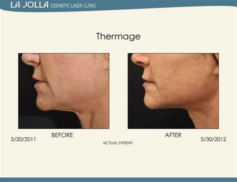 Patient Treated With Thermage At La Jolla Cosmetic Laser Clinic