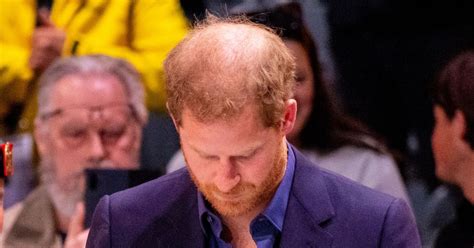 Prince Harry ‘close To Tipping Point Of Losing Hair Daily Star