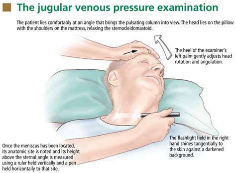 The Jugular Venous Pressure Revisited Abstract Europe Pmc