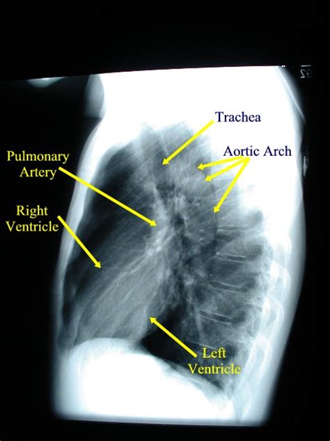 Chest X Ray
