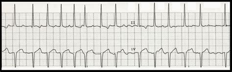 Float Nurse Ekg Rhythm Strip Quiz 186